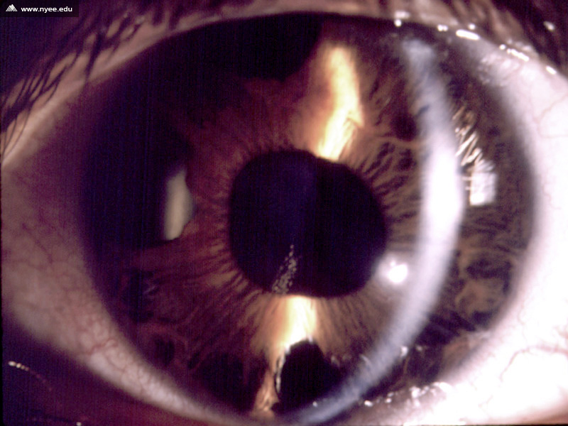 Progressive Iris Atrophy NYEE